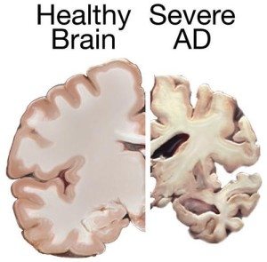 Brain atrophy in alzheimer's patient. Photo: National Institute of Health \ Wikimedia Commons