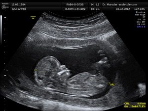 A baby in the womb Photo: Dr. Wolfgang Moroder / Wikimedia Commons